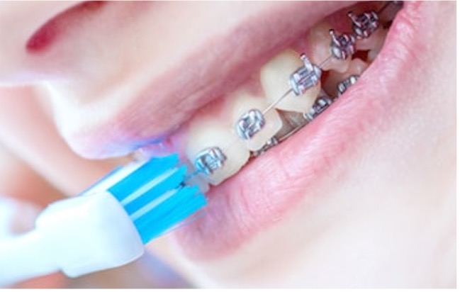 Cepillo especial para dientes con brackets