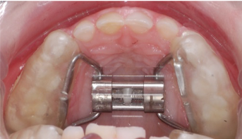 Ortodoncia infantil - Compresion de paladr con expansor o disyuntor 1