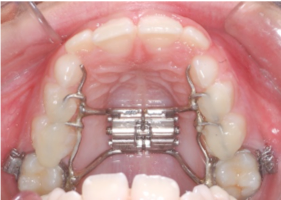 Ortodoncia infantil - Compresion de paladr con expansor o disyuntor 2