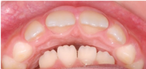 Ortodoncia infantil - Maxilar adelantado-mandibula retrocedida 2