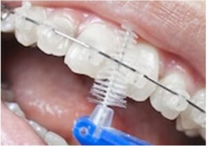 Cómo Cepillarse Los Dientes Con Brackets - Clínica Dental Soler