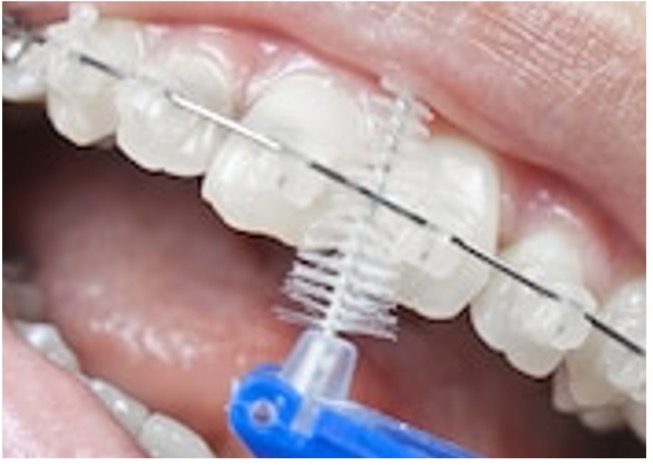Cepillo interproximal en cepillado de dientes con brackets