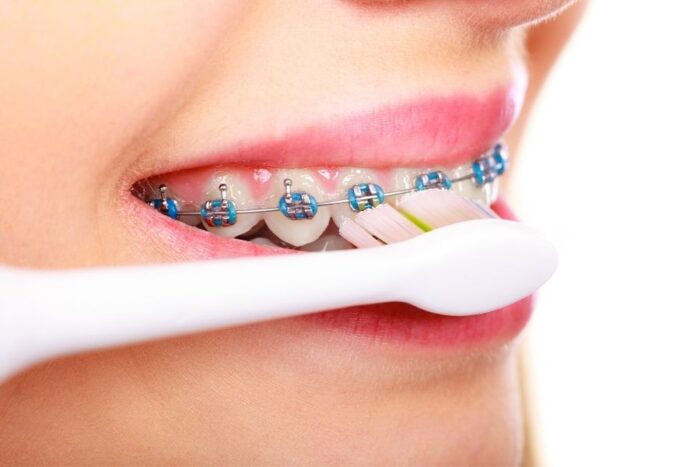 Cómo Cepillarse Los Dientes Con Brackets - Clínica Dental Soler